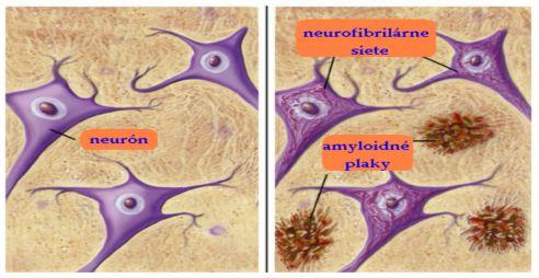 Alzheimerova choroba senilné plaky, β-amyloidný peptid, τ- bohaté neurofibrilárne