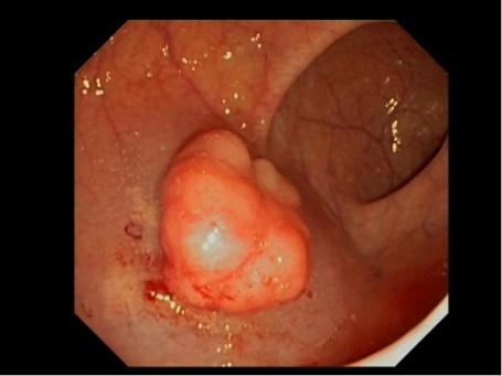 Ταξινόμηση τηs δυσπλασίας Polypoid Non-polypoid Endoscopically invisible Paris