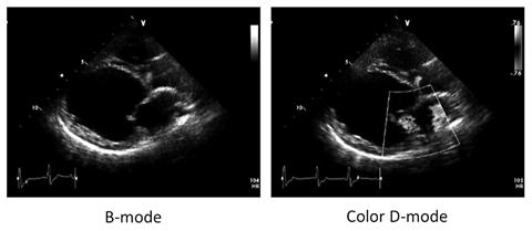 Mitral regurgitation, MR MR MR MR Chronic Degenerative valvular disease, CDVD Myxomatous mitral valve disease,