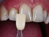 3.3. Odabir nijansi gleđi i dentina Pre sušenja odaberite nijansu.