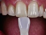 U prvom koraku izaberite nijansu dentina, a u drugom nijansu gleđi. Ako pacijent želi svetliju boju zuba, potrebna je restauracija svih prednjih zuba. 3.4.
