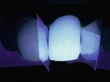 Ako prvo treba ukloniti ispune, faseta COMPONEER se može postaviti sa odgovarajućom dentinskom masom i ispuniti