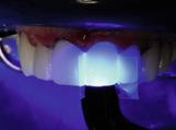 prednjih zuba, preporučuje se da počnete od dva centralna