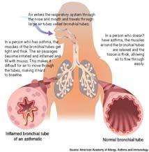 Άσθμα (όπως ορίζεται από την GINA) Το άσθμα είναι μια χρόνια φλεγμονώδης διαταραχή των αεραγωγών στην οποία συμμετέχουν πολλά είδη κυττάρων, ιδιαίτερα τα σιτευτικά, τα ηωσινόφιλα και τα Τ-