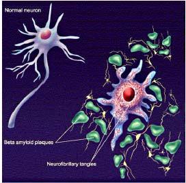 Παθογένεια της νόσου Alzheimer Νευριτικές πλάκες- Εξωκυττάριες αποθέσεις β αμυλοειδούς πεπτιδίου (Αβ), Νευροϊνιδιακά τολύπια Συγκέντρωση νευροϊνιδιακών αλλοιώσεων μέσα στο κύτταρο που οφείλονται στη
