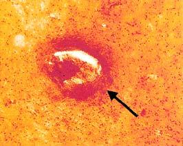 Κηλίδες Ψευδαργύρου σε μικρά αγγεία του ιπποκάμπου, σε ασθενή με τη νόσο Alzheimer.