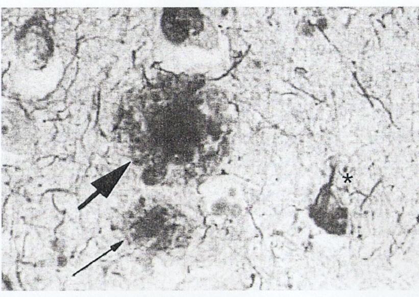 Εικόνα 4. Amyloid plaques (arrows) and neurofibrillary tangle (star) stained by the Bielshowsky silver impregnation method. A full colour version of this image is shown in the plates section.