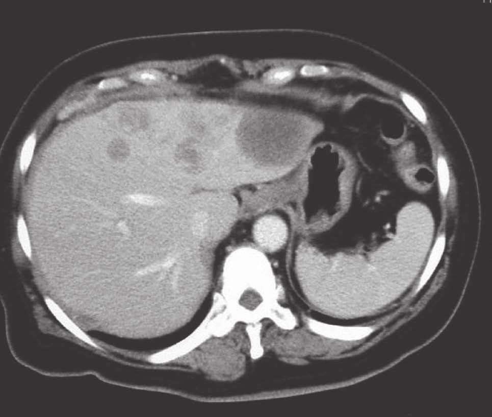 34 A case of hepatoid carcinoma 1. CT : Ring Enhancement low density 3.