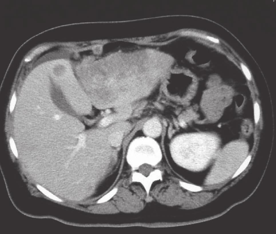 CT : Ring Enhancement Class V adenocarcinoma AFP alfa - fetoprotein 51.