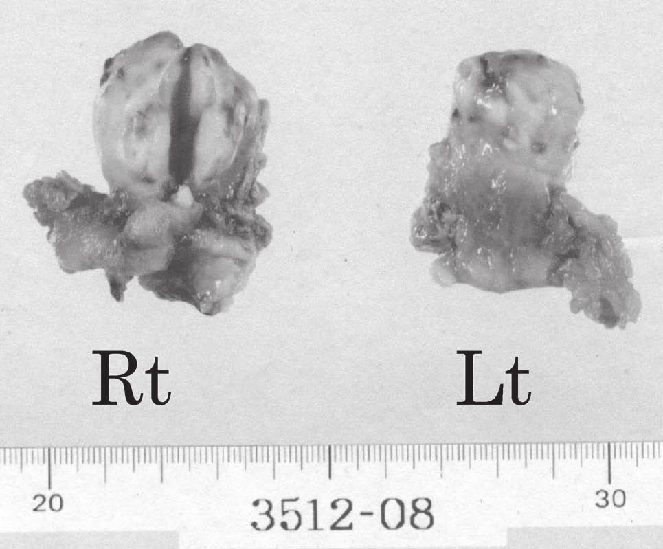 0 U/ml CEA Carcinoembryonic antigen CA - 19-9 CA72-4 2 cm 3 cm AFP CK