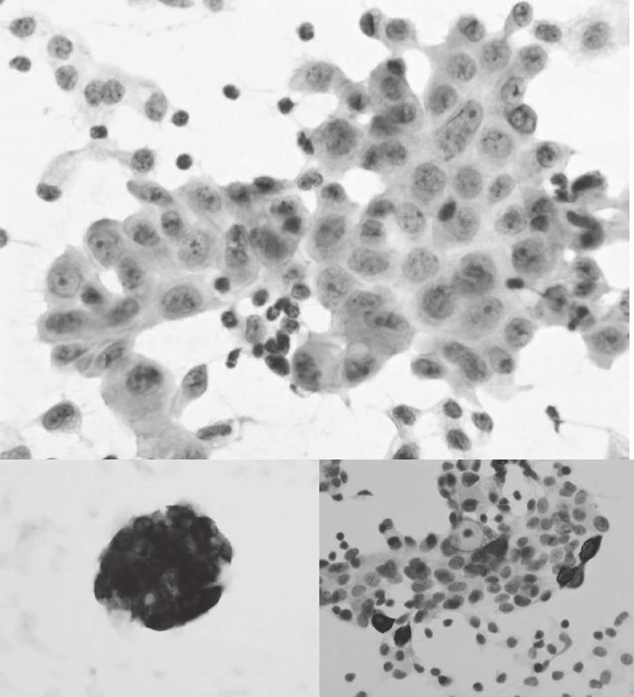 35 4 : Adenocarcinoma : CK7 : CK20 6.
