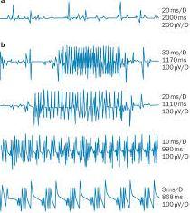 Hinman s Syndrome -Elimination Syndrome Mη νευρογενής - νευρογενής κύστη ΌΧΙ ΜΟΝΟ στα παιδιά Ενήλικες (PUD) Συχνά ψυχιατρικό υπόβαθρο Στις σοβαρές περιπτώσεις οδηγεί μέχρι και σε νεφρική ανεπάρκεια