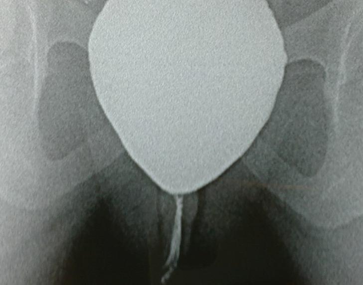 Primary Bladder Neck Obstruction Πρωτοπαθής Απόφραξη Κυστικού