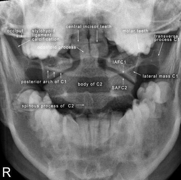Διαστοματική προβολή οδόντα Central incisor teeth : κεντρικοί τομείς Odontoid process : οδόντας Posterior arch of C1 : οπίσθιο