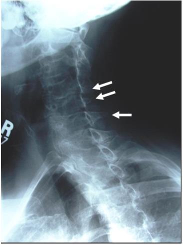 Case 31 The main problem with this radiograph is that the spinous processes are not superimposed over the transverse processes (arrows).