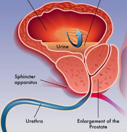 Η αύξηση της μεταβατικής ζώνη του αδένα (περιβάλλει την ουρήθρα κοντά στην κύστη) Παρατηρείται μετά τα 40 έτη