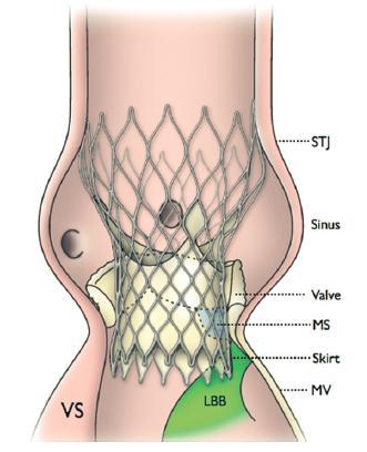 Conduction Abnormalities after TAVR The most common complication due to: Direct