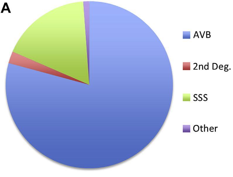 ECG criteria for PPI after TAVR 13%