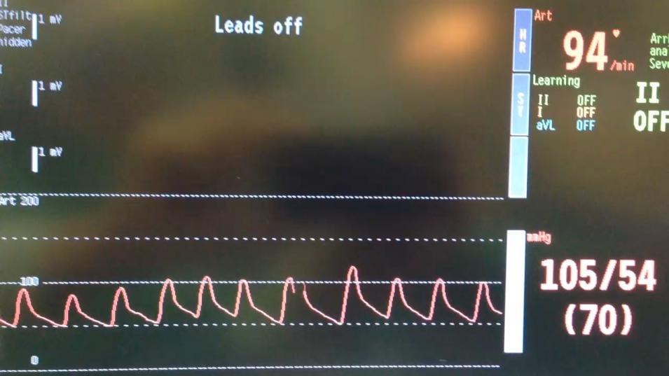 Acute MR after TAVR,