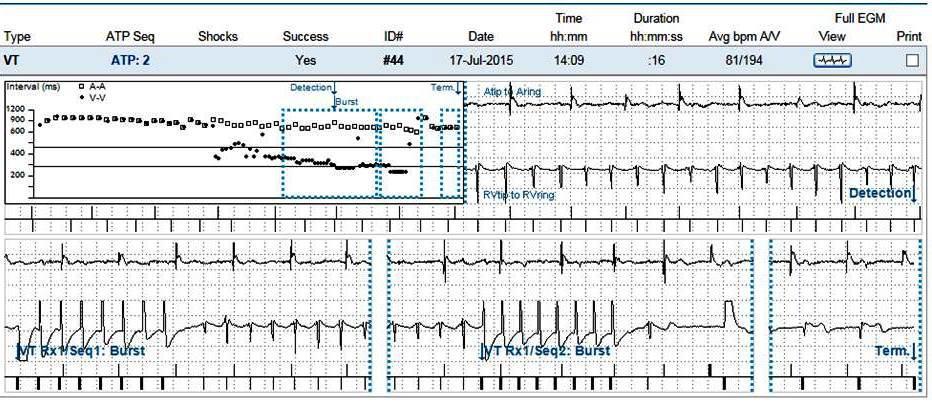 arrhythmias