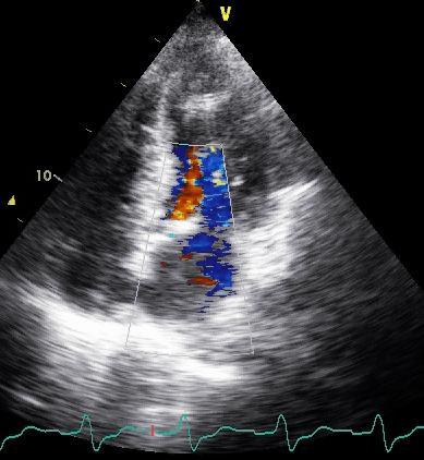 Deterioration of mitral