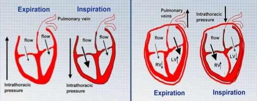 ΠΑΘΟΦΥΣΙΟΛΟΓΙΑ Κατά την εισπνοή: Η κλίση πίεσης ελαττώνεται στην αριστερή κοιλία Έχουμε εισπνευστική μείωση πλήρωσης της αριστερής κοιλίας Η κλίση πίεσης των κοίλων φλεβών και της δεξιάς