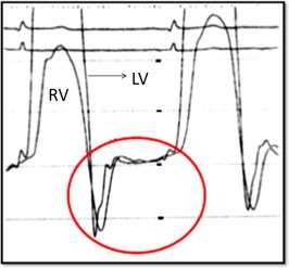 ΑΙΜΟΔΥΝΑΜΙΚΑ ΕΥΡΗΜΑΤΑ Καταγραφή πίεσης στις δύο κοιλίες εμφανίζει μεγάλη πρωτοδιαστολική κάθοδο ακολουθούμενη