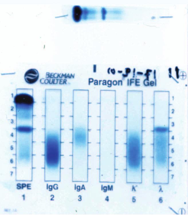 Οι τεχνικές της Η/Φ και της ΑΚΘ πρωτεϊνών συμπυκνωμάτων ούρων, δεν παρουσιάζουν διαφορές από τις αντίστοιχες των πρωτεϊνών του ορού 9,10.