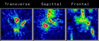 5. Prezentácia tomografického obrazu Základné tomografické roviny: A. TRANSVERZÁLNA leží kolmo na dlhú os tela pacienta. (Je to klasická rovina pre CT a je vhodná pre obrazy fúzie PET- CT / SPET-CT).