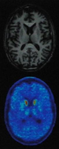zobrazenie pomocou PET-MRI umožňuje