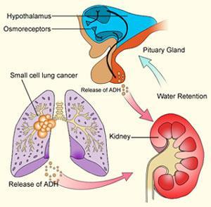 SIADH Hypothalamus receives feedback from: Osmoreceptors Aortic arch baroreceptors Carotid baroreceptors Atrial stretch