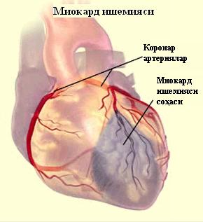 Bir tomondan kapilyar bazal membranasi qalinlashuvi xos bo`lgan