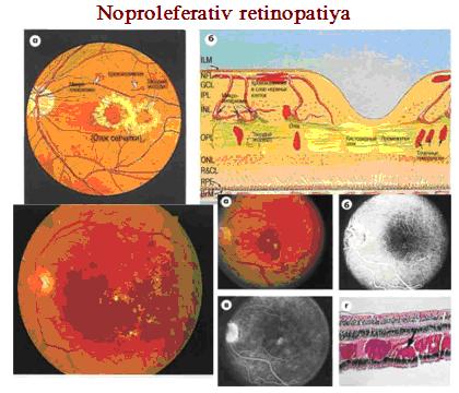 Diabetik retinopatiya klassifikatsiyasi. (жаdваl 2) 1.