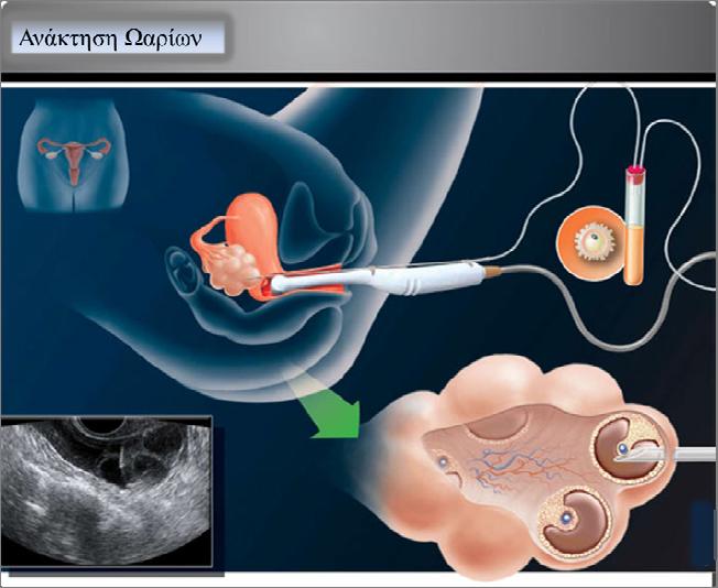 Εικόνα 5. Διαδικασία ανάκτησης ωαρίων από την ωοθήκη (http://www.berlin-baby.co.uk). Γ.