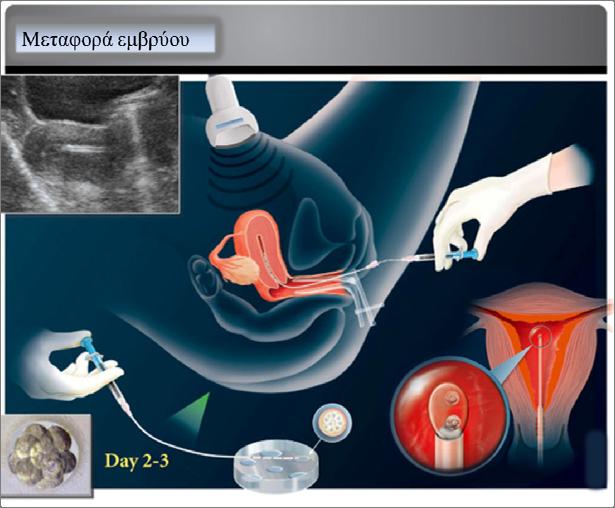 Εικόνα 11. Διαδικασία μεταφοράς εμβρύου (http://www.berlin-baby.co.uk). Ε.