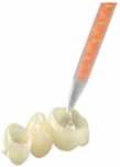 Το Tempofill απομακρύνεται εύκολα ολόκληρο ή τμηματικά χωρίς τη χρήση micromotor έτσι ώστε να μην καταστρέφει τα όρια της παρασκευής. Αφαιρείται εύκολα με τη χρήση κοχλιαρίου οδοντίνης.