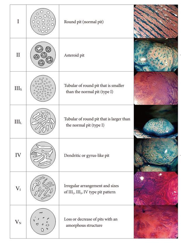 type I: round pits; The different colonic staining patterns are categorized according to the Kudo pit pattern classification which predicts histology with good accuracy (81.5%).