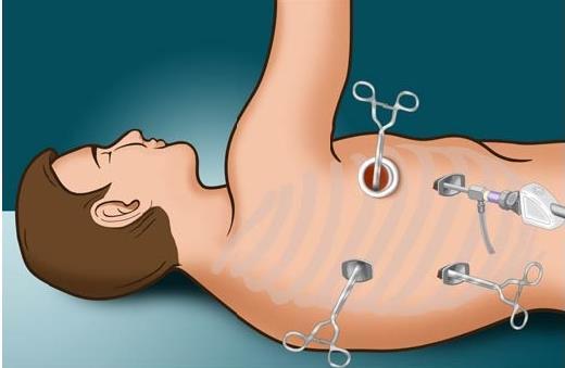 Figure 1. In VATS, the surgeon makes three to four small incisions (ports), and uses a telescope to see inside the chest, without any retractors or rib spreading.