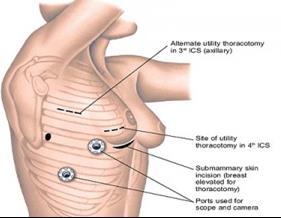 that are located close to the major blood vessels or airway where these enter the lung or larger tumors associated with tumor spread to lymph nodes in the central regions of the lung may require the