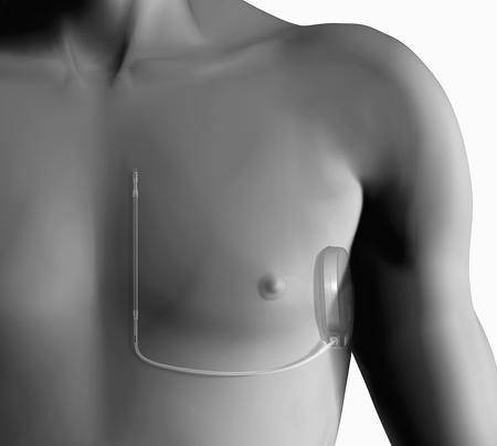 Keď bude základná úroveň stabilná a snímanie bude prebiehať správne, nastavte režim zariadenia na Therapy On (Liečba zapnutá) a v prípade potreby otestujte defibriláciu.