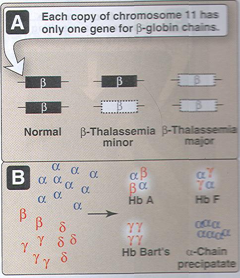 β-talasemija - pomanjkanje β verige hemoglobina
