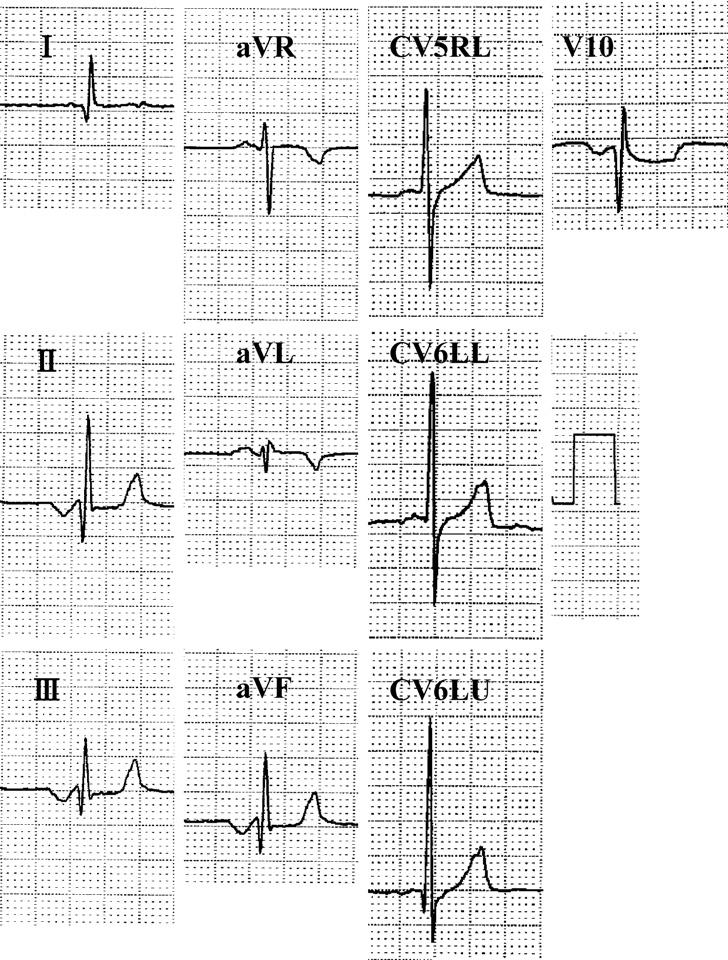 P P 1 1 1 II, III, avf, V10 P 10 mm/mv, 50 mm/sec. 1 1 3 24.8 kg 38.