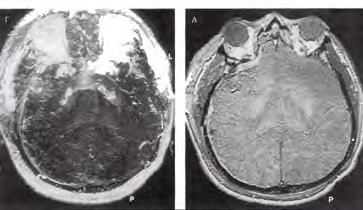 Κυματομορφή με αναστροφή των ταχυτήτων ροής στη διαστολική φάση (εγκεφαλικός θάνατος) Αξονική τομογραφία Η αξονική τομογραφία χρησιμεύει κυρίως στον προσδιορισμό της αιτίας του εγκεφαλικού θανάτου (π.