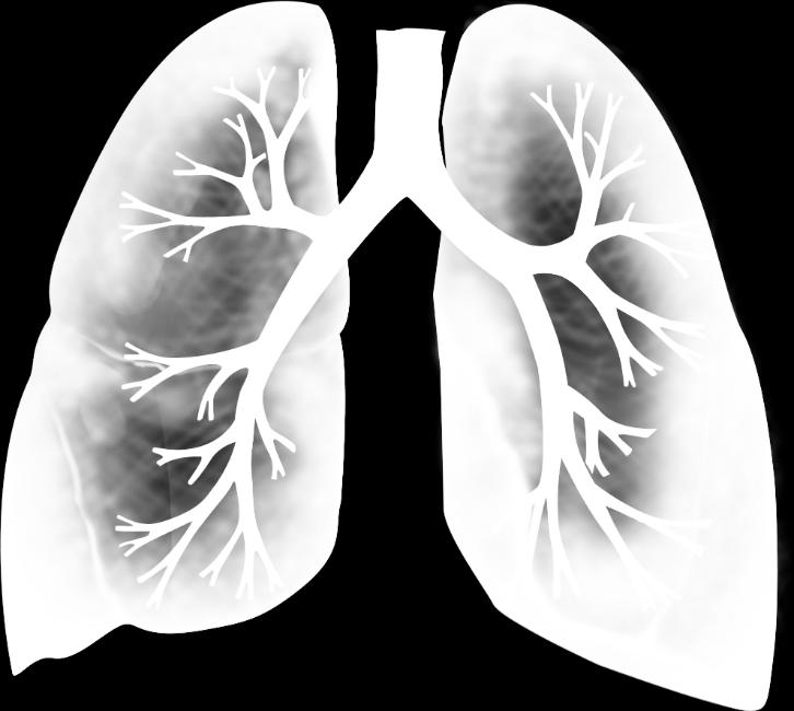 Η φλεγμονή του πνεύμονα (και άλλων βλεννογόνων;) πυροδοτεί ΝΕΤωση και παραγωγή IgA ACPA Γενετική προδιάθεση ΑΠΚ Καπνός, άλλα εισπνεόμενα ερεθιστικά Ενεργοποιημένο Τ κύτταρο Φλεγμονή πνεύμονα Β