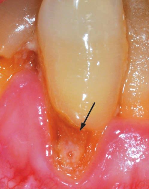 ΣΚΛΗΡΟΙ ΟΔΟΝΤΙΚΟΙ ΙΣΤΟΙ 15 EIKONA 1 Bλάβη δοντιού στην αυχενική περιοχή. Το μασητικό της όριο εδράζεται στην αδαμαντίνη και το αυχενικό στην οδοντίνη.