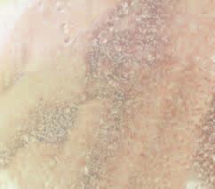 Mydlo alebo silne penivé sprchové gély odmasťujú pokožku ešte viac. Následok: pokožka je zdrsnená a citlivá.