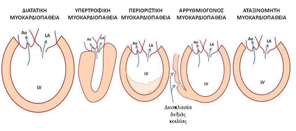 Οι καρδιομυοπάθειες (cardiomyopathies), ή μυοκαρδιοπάθειες, αποτελούν ετερογενή ομάδα νοσολογικών οντοτήτων.