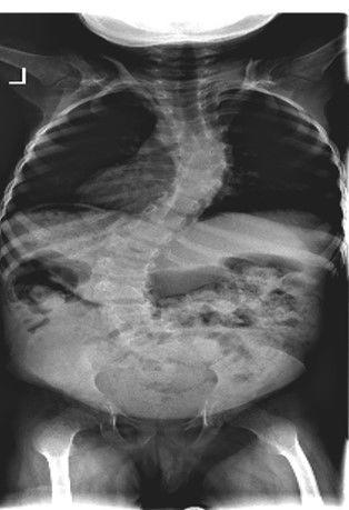 Η σκολίωση που εμφανίζεται πριν από την ηλικία των 5 ετών έχει τη χειρότερη πρόγνωση, με διαταραγμένη ανάπτυξη πνευμόνων και θωρακικού κλωβού.
