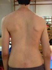 Jan 10;13:3 doi: 101186/s13013-017-0145-8 ecollection 2018 Schroth Barcelona Scoliosis Physical Therapy School ( BSPTS)