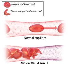 Συνέπειες δρεπανοκυτταρικής αναιμίας o Η μετάλλαξη οδηγεί σε αλλαγή της στερεοδιάταξης της αιμοσφαιρίνης, η οποία έχει ως αποτέλεσμα την αλλαγή της μορφής των ερυθροκυττάρων, τα οποία, σε συνθήκες